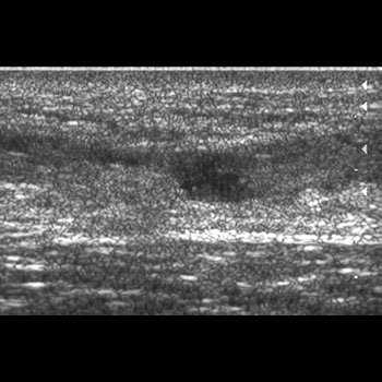 Ecografie - studiu de caz