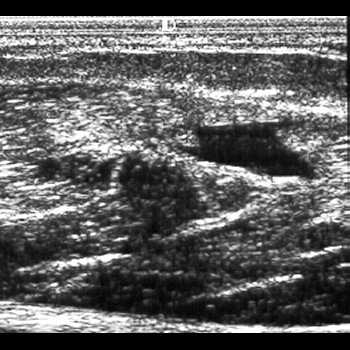 Ecografie - studiu de caz